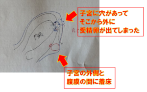 子宮外妊娠　不妊治療