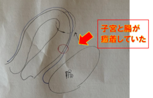 子宮外妊娠　不妊治療