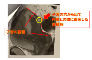 子宮外妊娠　不妊治療