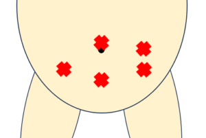 子宮外妊娠　不妊治療